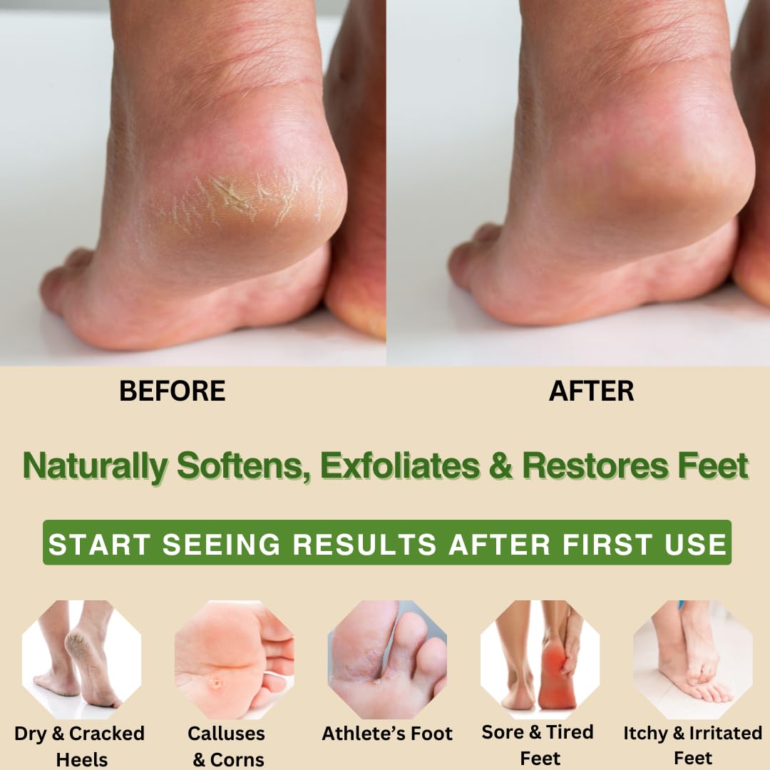 Natural Escapes Peppermint, Rosemary, Eucalyptus & Tea Tree Oil Foot Cream for Dry Feet, Cracked Heels, Calluses, Athlete's Foot - Heel Repair Cream for Women & Men (8 oz)