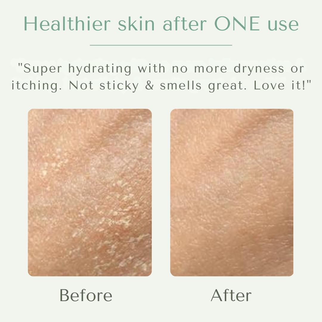 Yobee Body & Face Cream for Dry, Itchy Skin, Eczema & Psoriasis, Dermatologist Formulated, Probiotics, Honey, Turmeric, Vitamins B12 & E, Ceramides, Shea Butter, Fragrance Free, For Kids & Adults