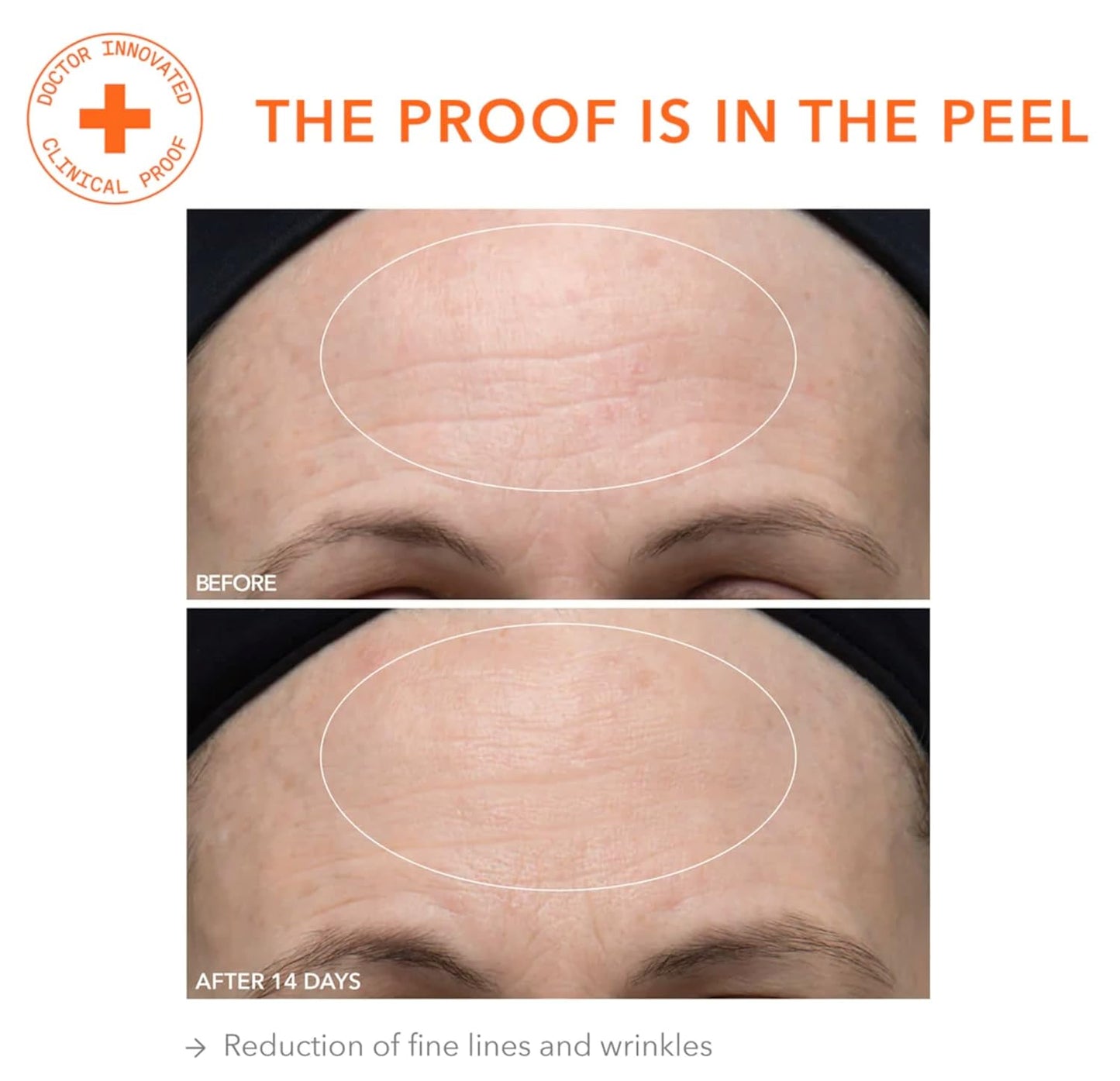 Dr. Dennis Gross Alpha Beta Ultra Gentle Daily Peel: for Dehydrated or Sensitive Skin, Uneven Tone or Texture, Fine Lines or Enlarged Pores (30 Treatments)