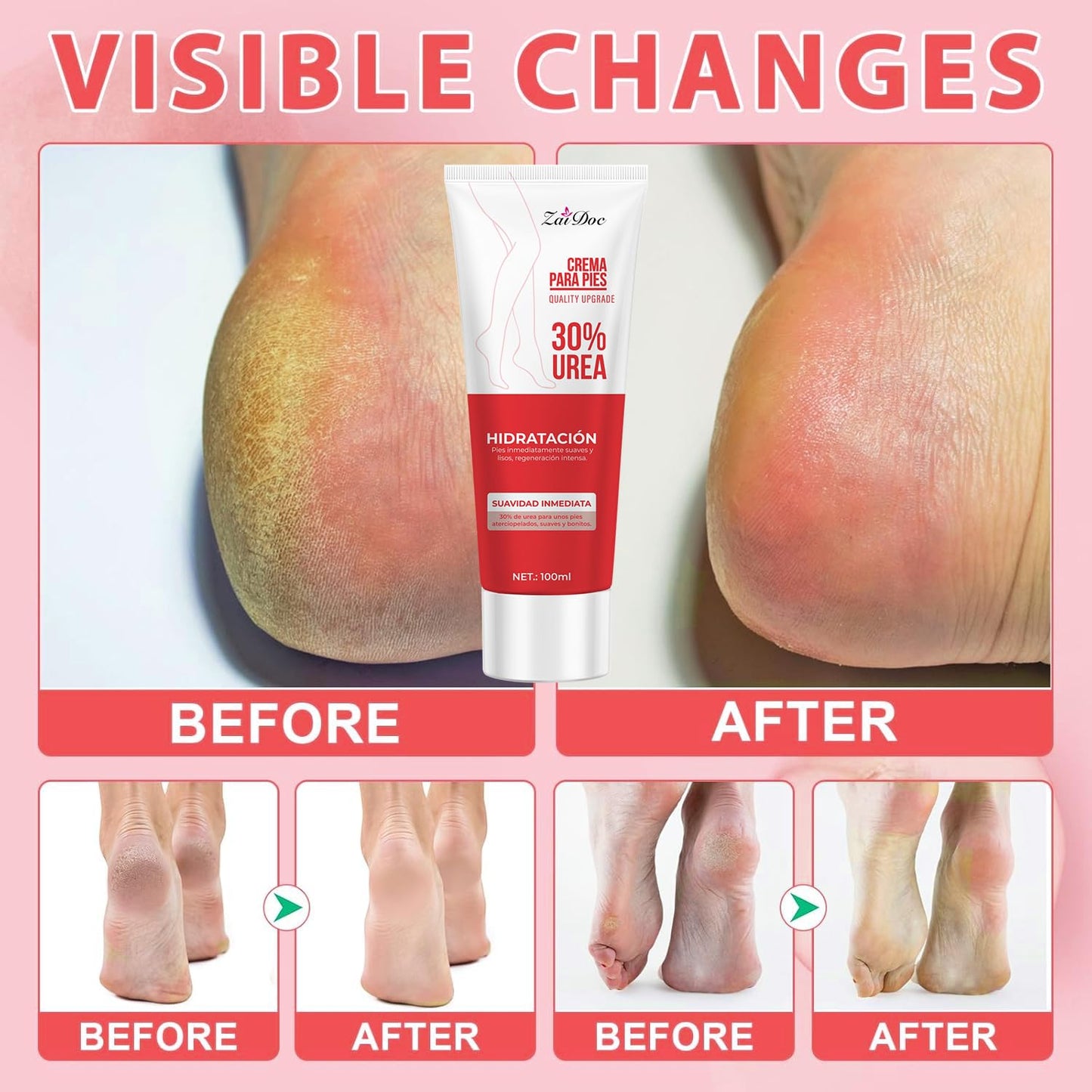 2 Pack Urea Cream 30 Percent for Feet 3.38 oz, Foot Cream and Hand Cream Maximum Strength with Hyaluronic Acid, Aloe Vera for Deep Moisturizes, Callus Remover