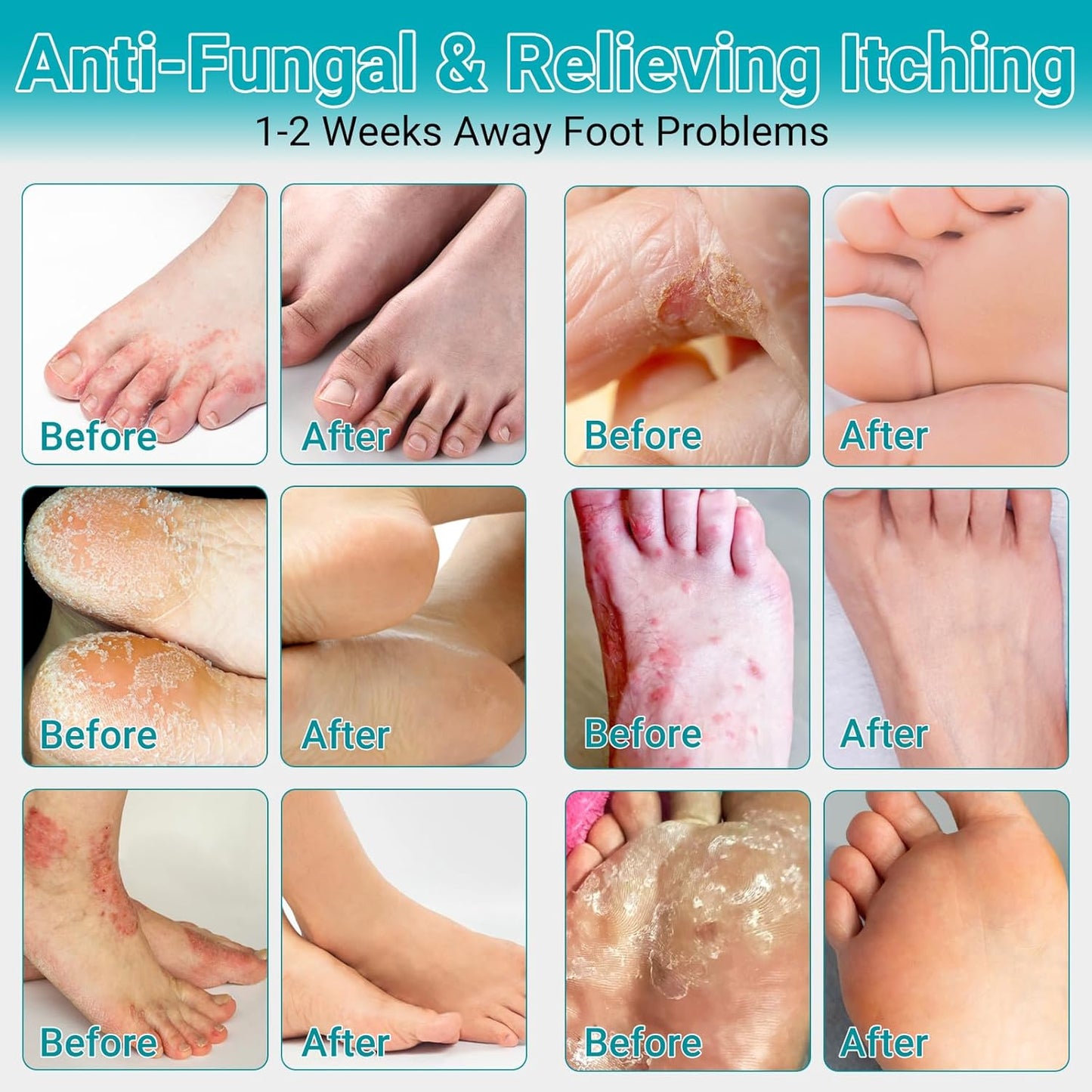Athletes Foot Treatment Cream, Maximum Strength for Athlete's Foot (Tinea Pedis), Itching, Blister, Burning, Cracking, Scaling, Beriberi,Natural Herbs Antifungal Foot Cream