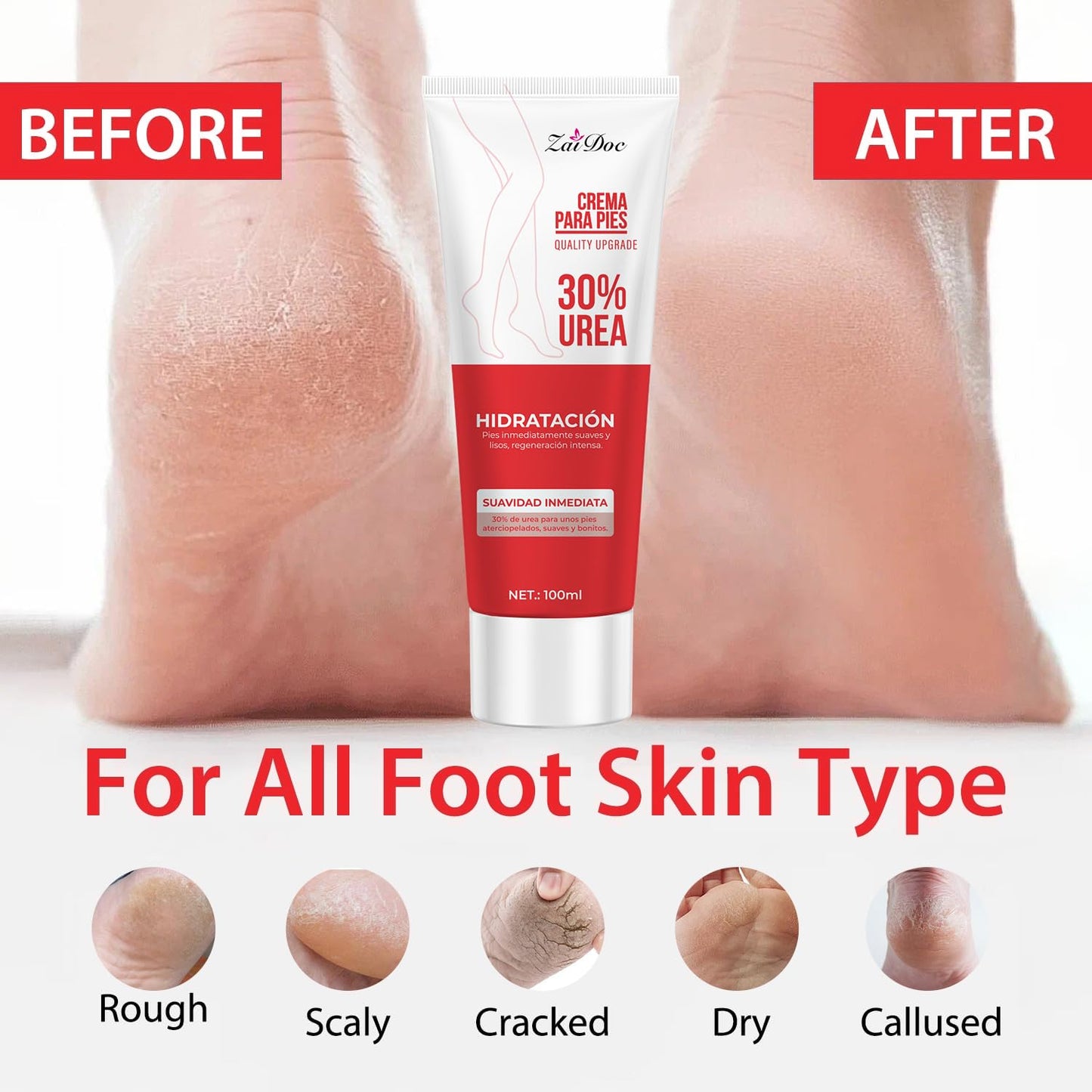 2 Pack Urea Cream 30 Percent for Feet 3.38 oz, Foot Cream and Hand Cream Maximum Strength with Hyaluronic Acid, Aloe Vera for Deep Moisturizes, Callus Remover