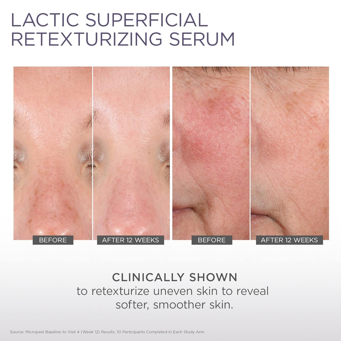 Glytone Micro-Peel Lactic Superficial Retexturizing Serum | Anti-Aging AHA Exfoliating Serum for Face with 10% Lactic Acid | Hydrates, Brightens & Reduces Wrinkles | Paraben-Free - 1 Fl oz