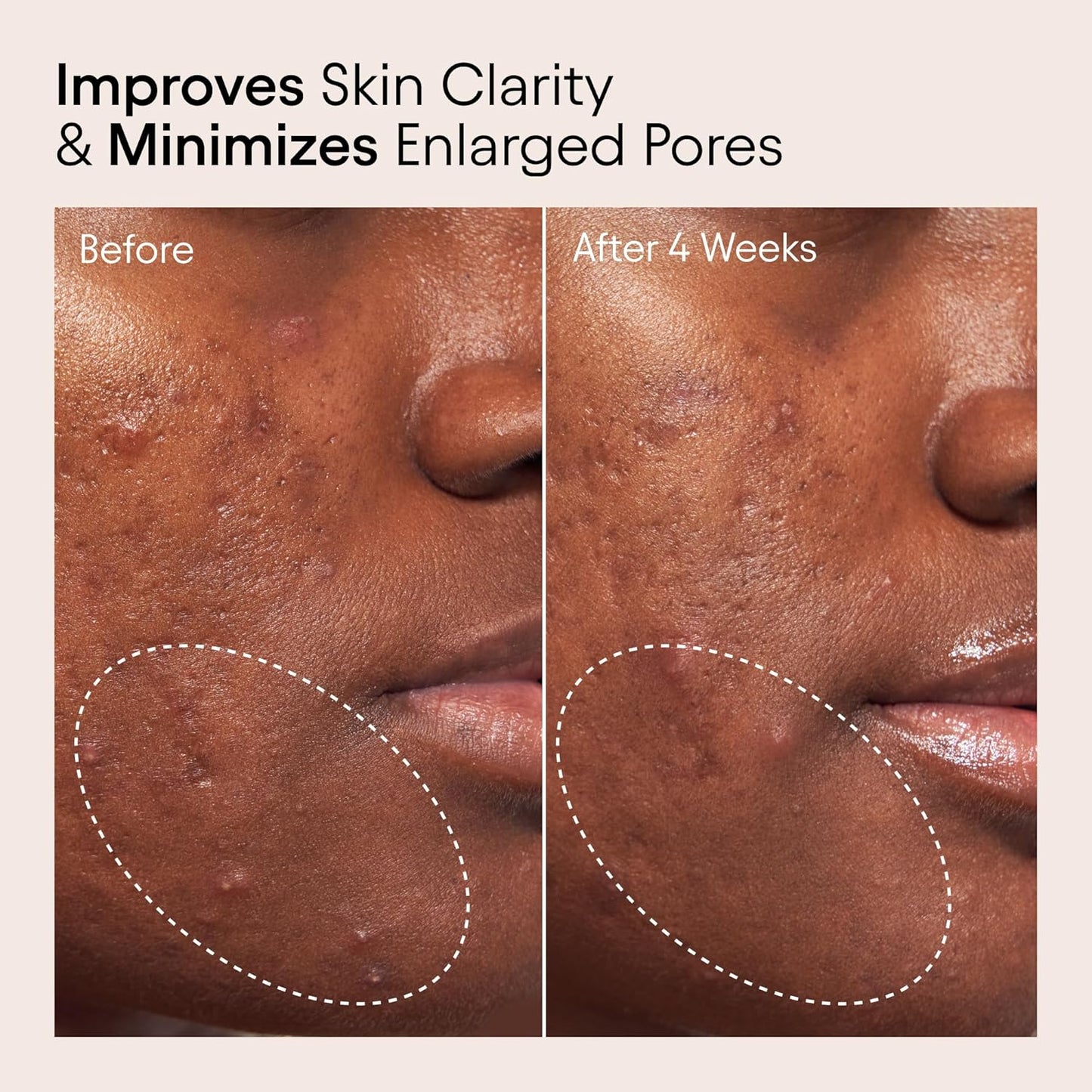 Alpyn Pore Perfecting Liquid Toner with 2% BHA & Borage | Liquid Exfoliator to Minimize Pores, Calm & Restore Skin's Natural pH | 4 oz / 120 ml